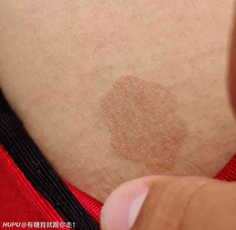今天下大雨没上班  突然发现大腿内侧有一个这样的斑 第一次有这