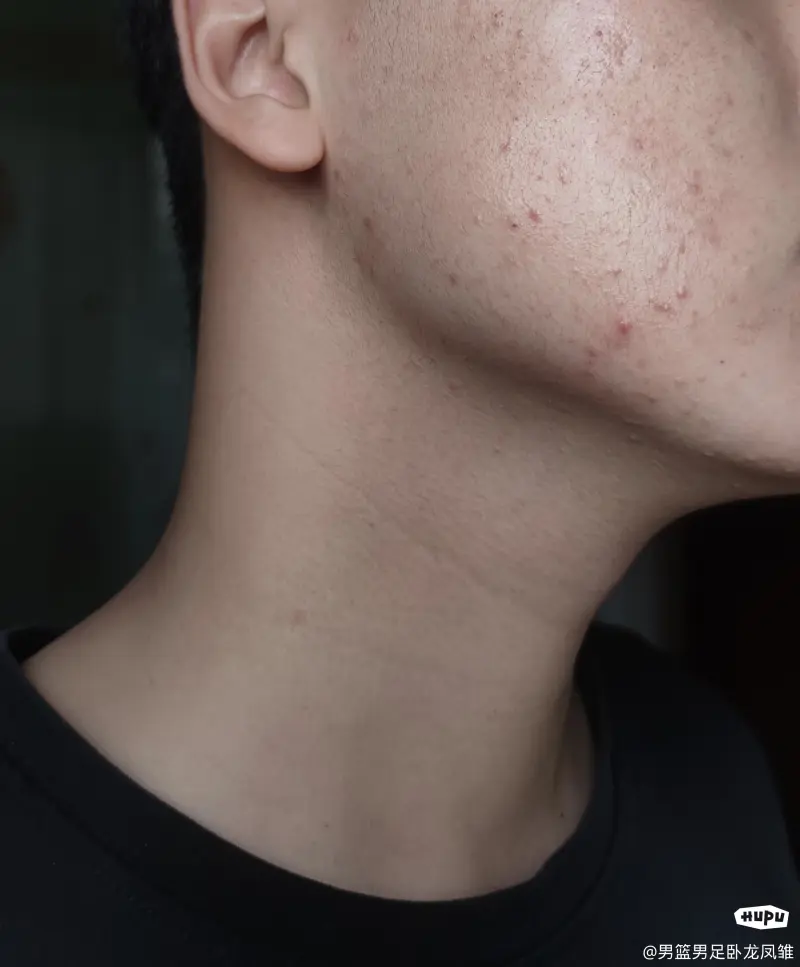 皮肤有炎症总长痘怎么办？