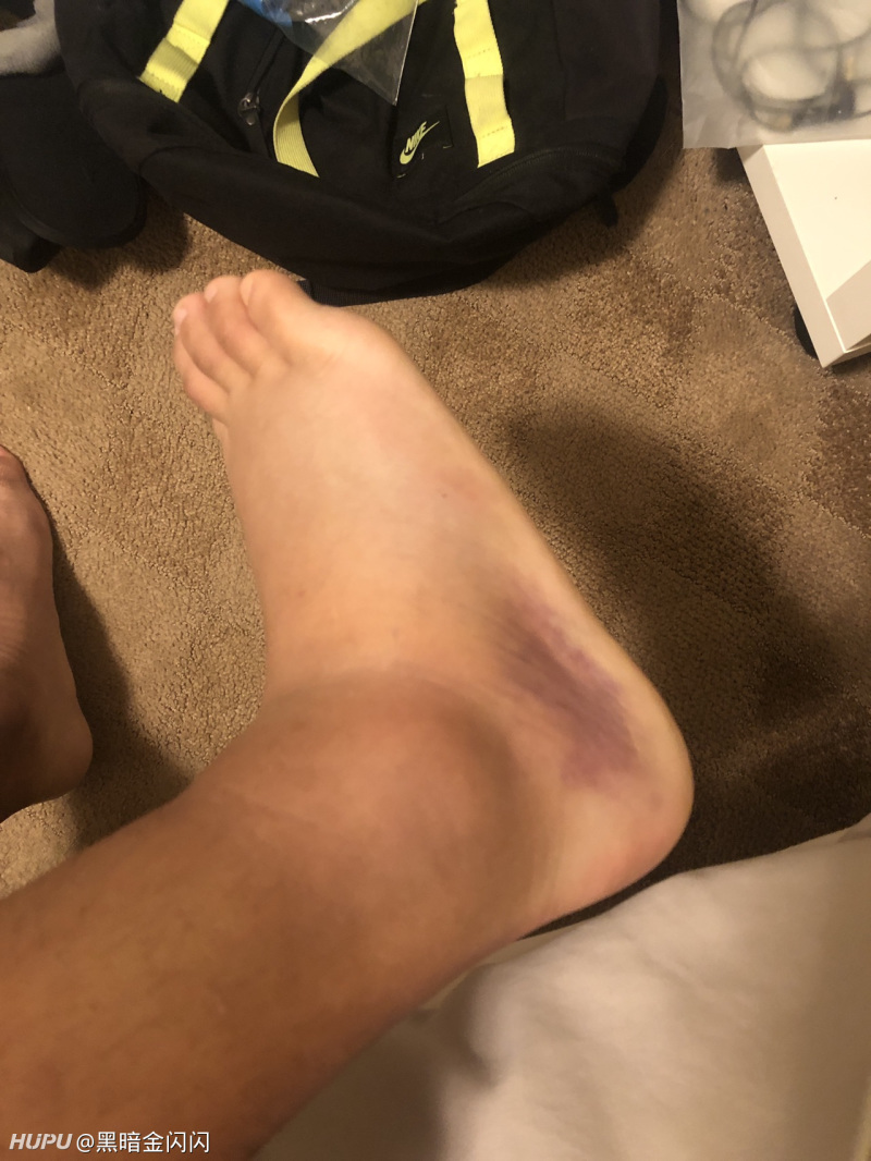 脚踝扭伤过了五天变黑了是正常的吗 有图慎入 虎扑