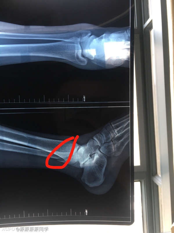 脚踝腓骨骨折手术后 Nba专区 虎扑社区