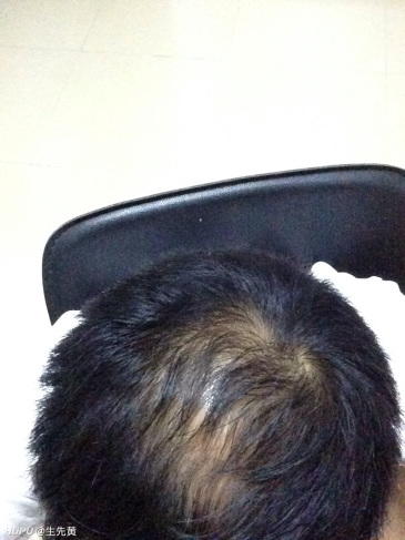 这样还有救吗?发际线也快移到后脑勺去了