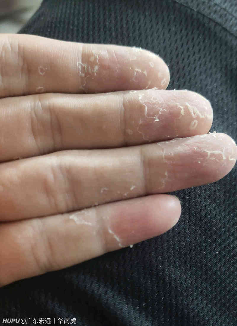 最近手指脱皮这是怎么回事求助