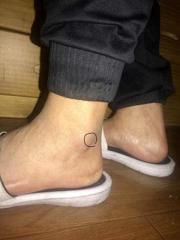 脚踝外侧骨头硬伤很难养好怎么办