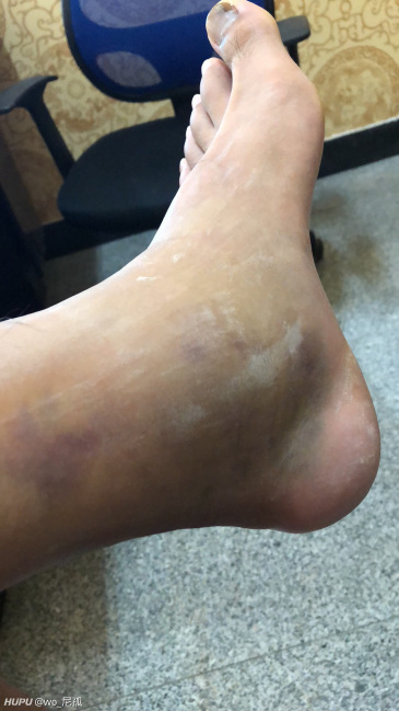 脚肿了多久能好啊