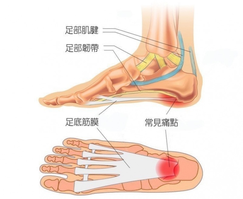 足底筋膜炎 虎扑 足底筋膜炎 虎扑