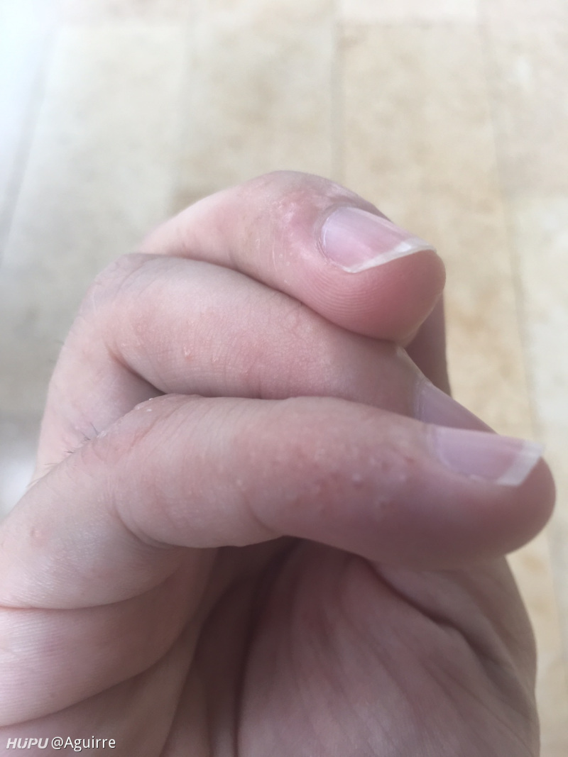 手上长了一粒粒的小水泡,奇痒难耐.各位能帮我看看是怎么回事吗