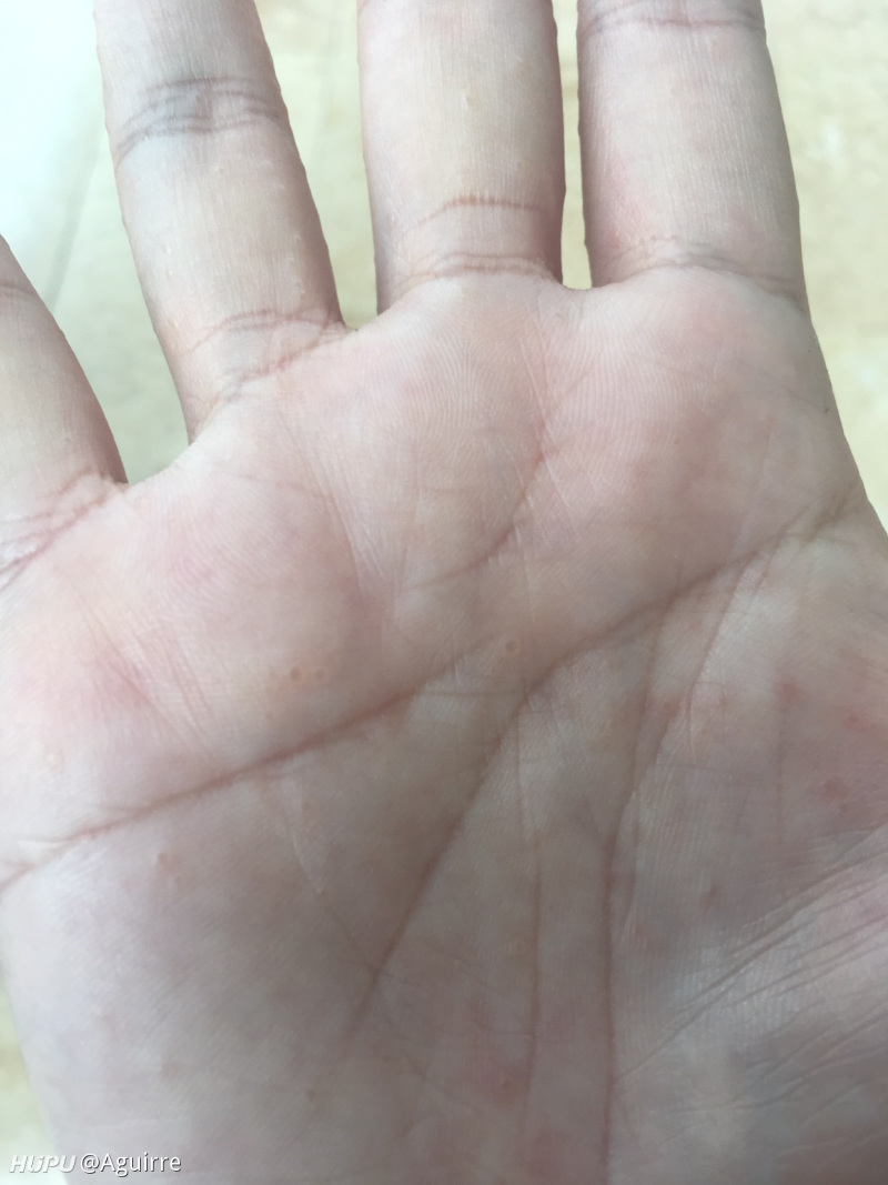 手上长了一粒粒的小水泡,奇痒难耐.各位能帮我看看是怎么回事吗
