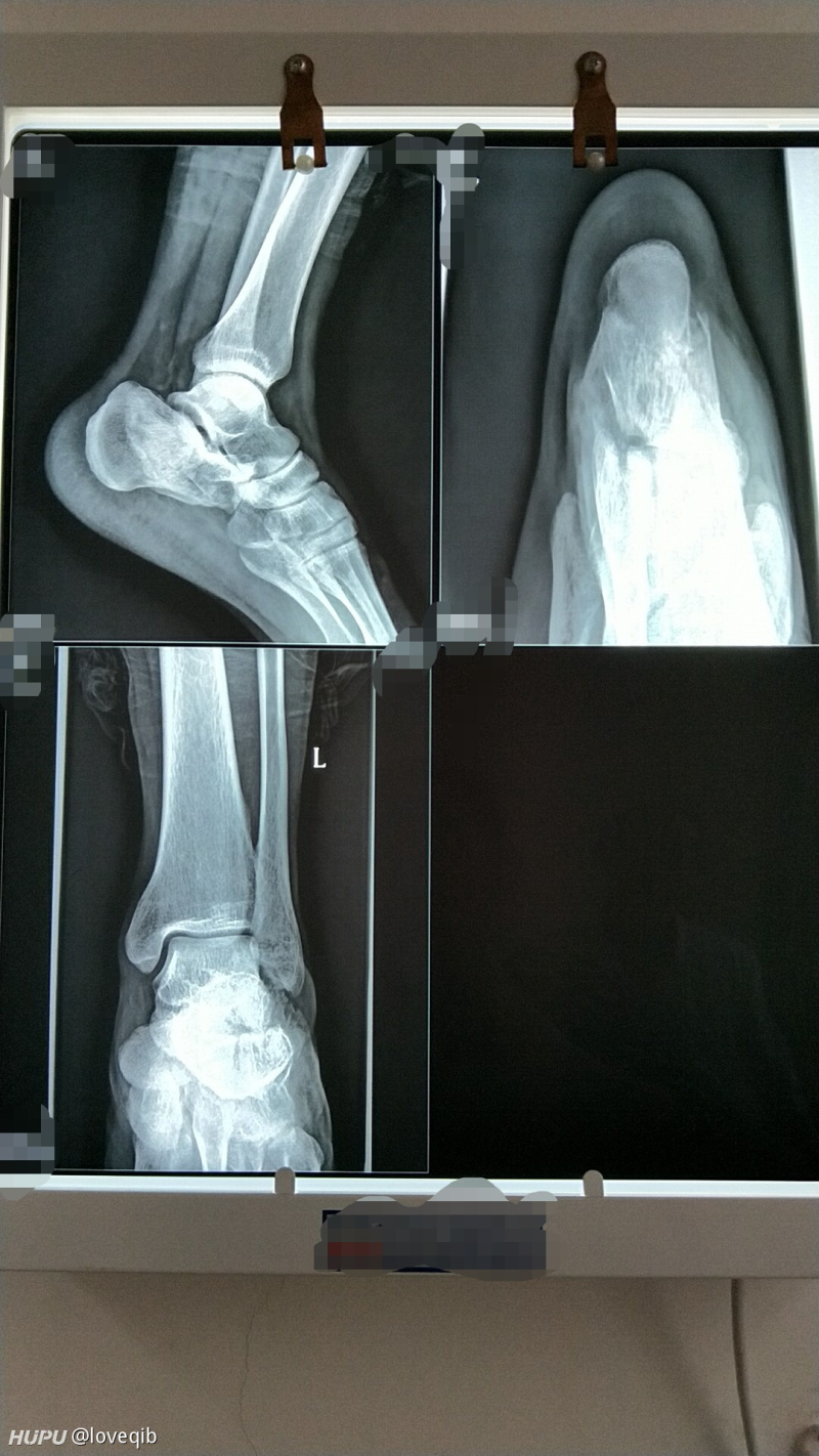 清明节不小心把脚后跟骨折了!现在术后一周了,每天晚上脚踝处还是很疼