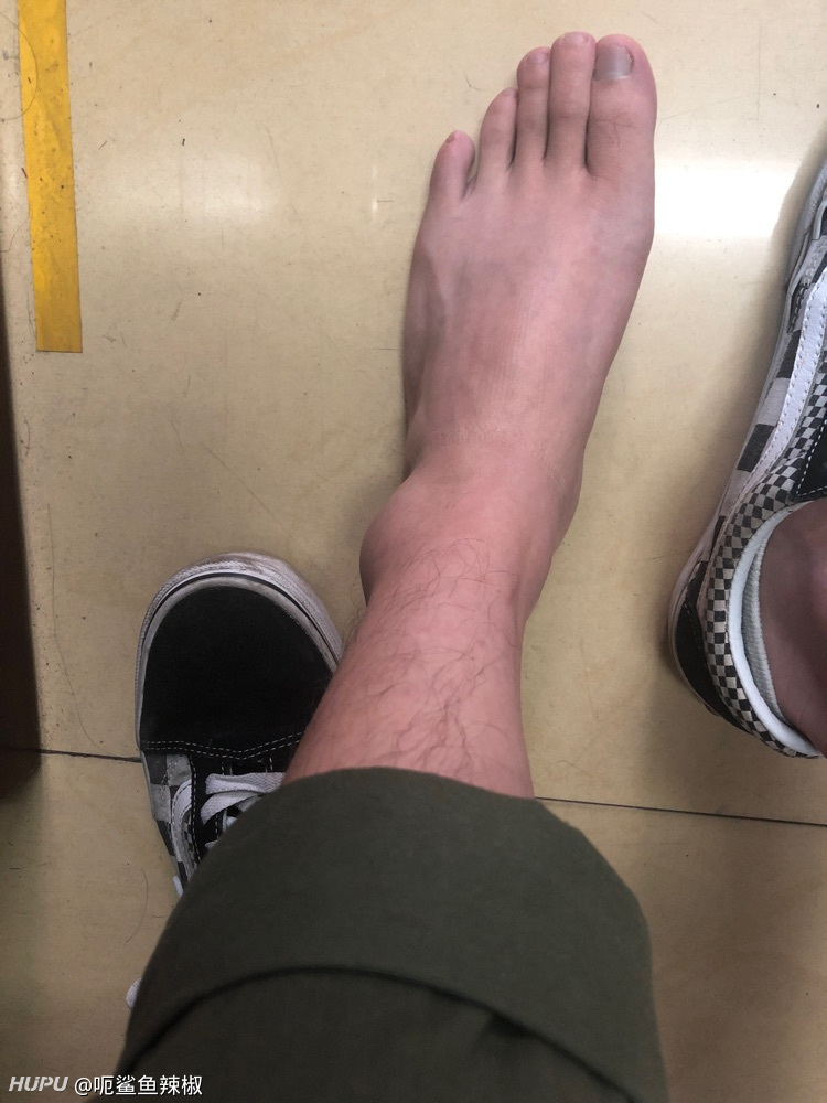 急!打球崴脚了怎么处理