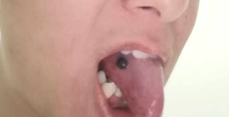 舌头上突然发现长了个紫黑色血泡 有人知道是啥吗 虎扑