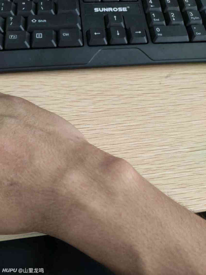 今天发现手背上鼓起,有点慌