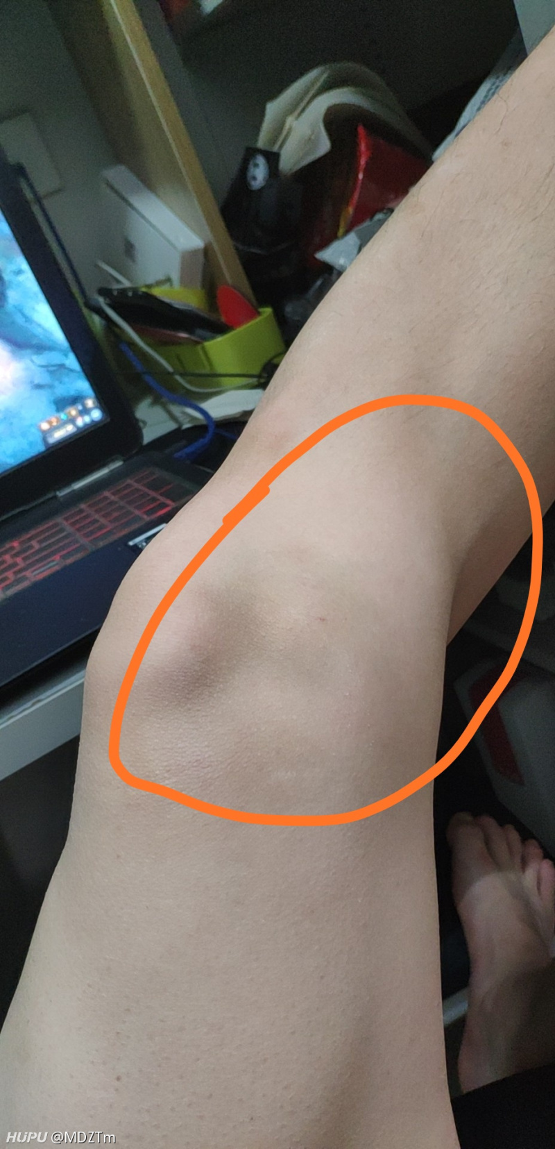 打球的时候膝盖侧面被撞,求问怎么办.