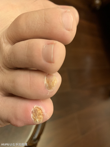 灰指甲会传染吗?