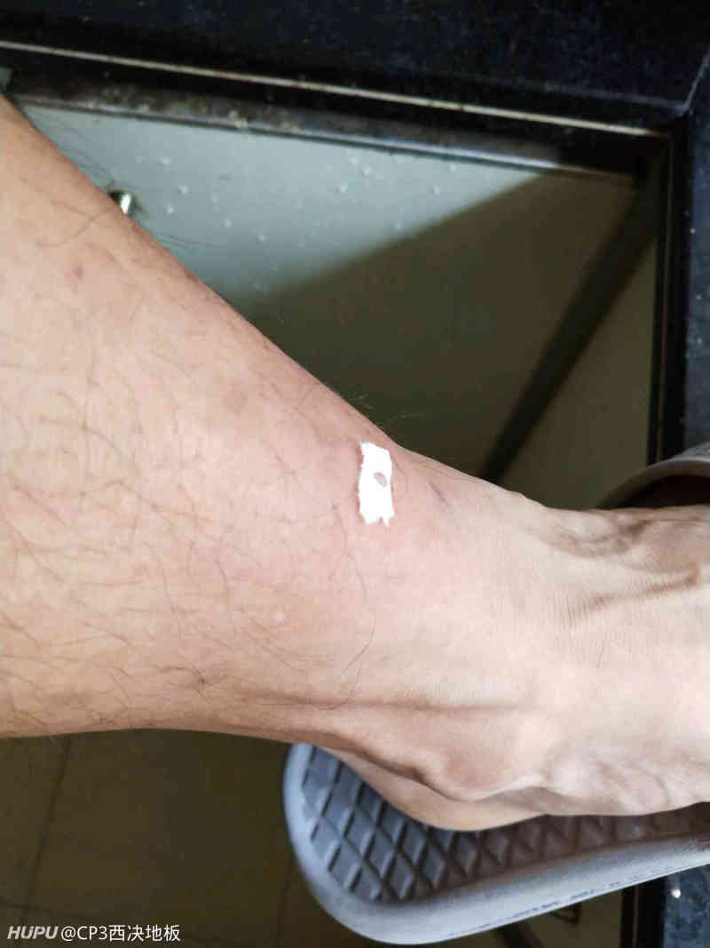 被蚂蚁咬了一口,起了一个大包,怎么处理