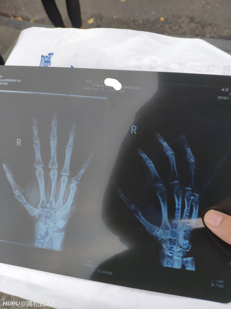 右手第四掌骨体骨折 欢迎有经验的jr来交流交流 虎扑