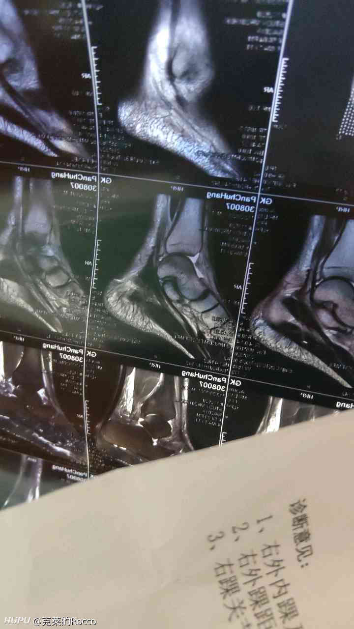 社区 步行街主干道上周打球落地时把jio给崴了,去医院拍了个核磁共振