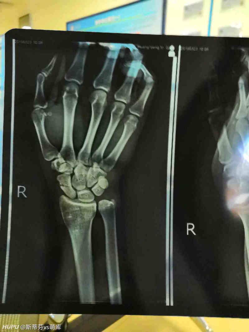 打球导致右手腕舟骨骨折 虎扑
