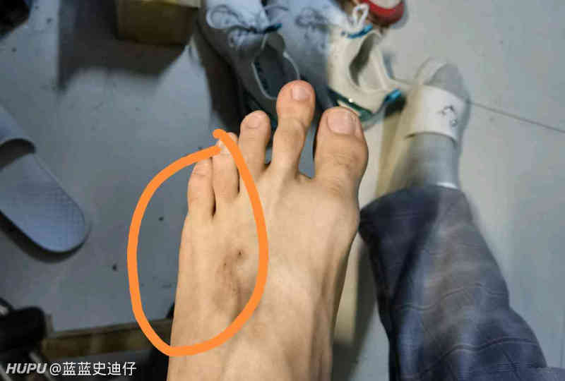 关于打篮球崴脚 虎扑