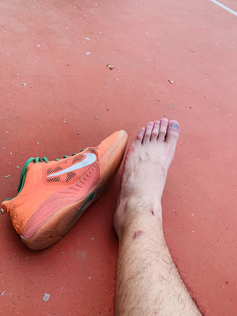 崴脚浮肿怎么消?