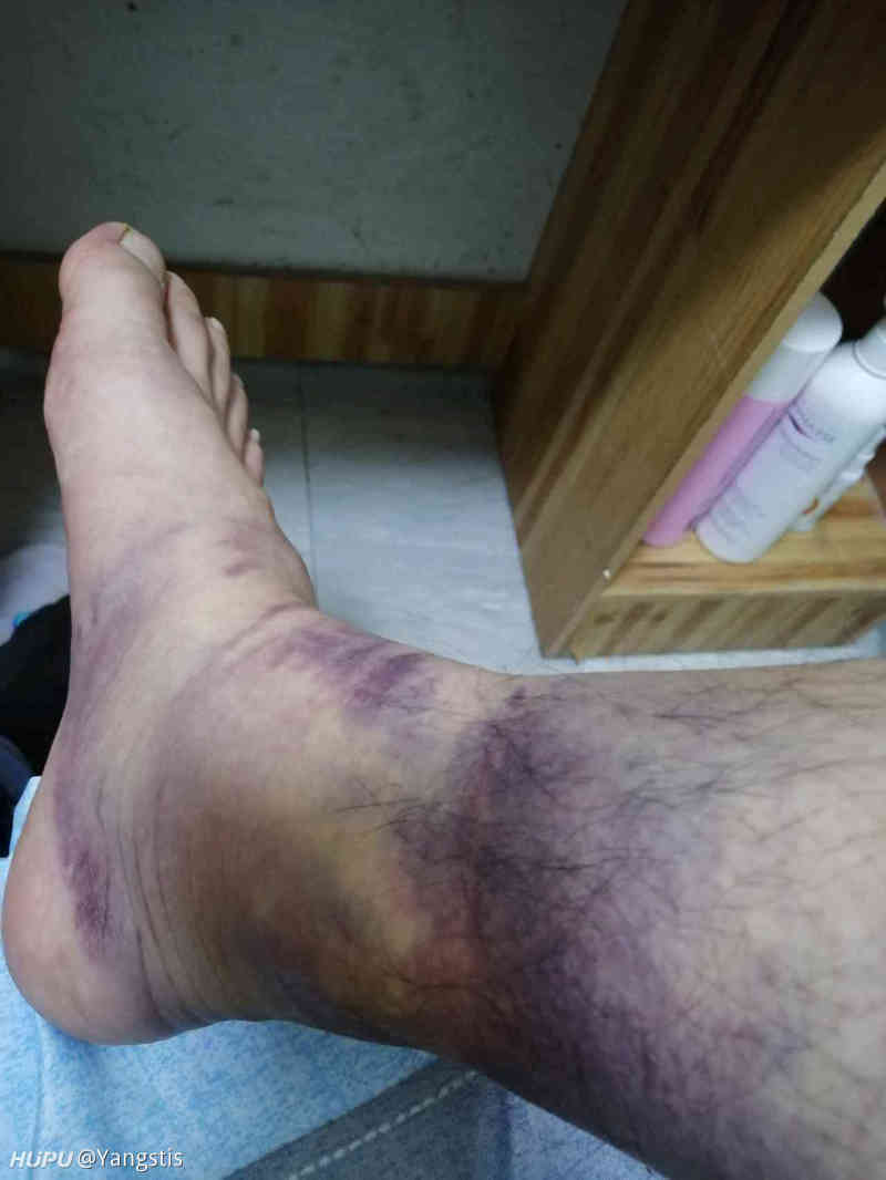 我的脚被车撞了,肿了有瘀血,能够走动