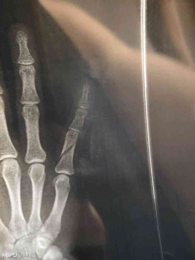 今晚打球小拇指错位骨折 有懂的老哥吗 虎扑