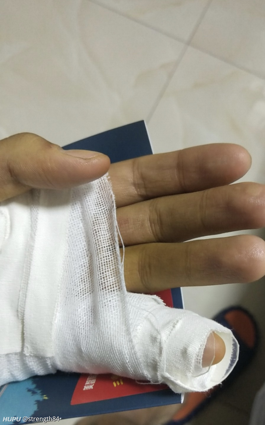 各位jrs有小拇指开放性脱臼经历吗