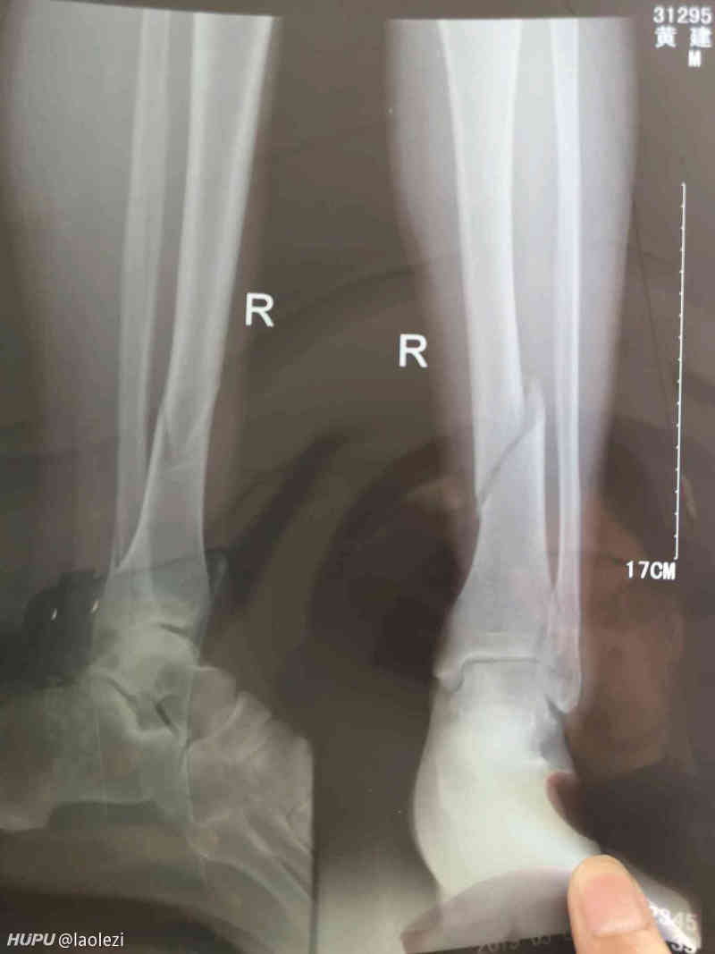 有骨科方面的jrs吗 求教 胫骨骨折了 有必要采用内固定的方法治疗吗 虎扑