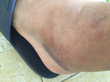 打球崴脚两天了 这么多瘀血有事吗