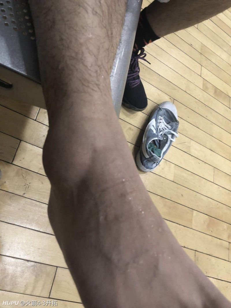 老哥们,我这崴脚严重嘛