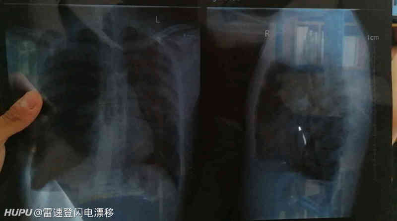 肺大疱破裂导致的气胸自愈后复发概率高吗 虎扑