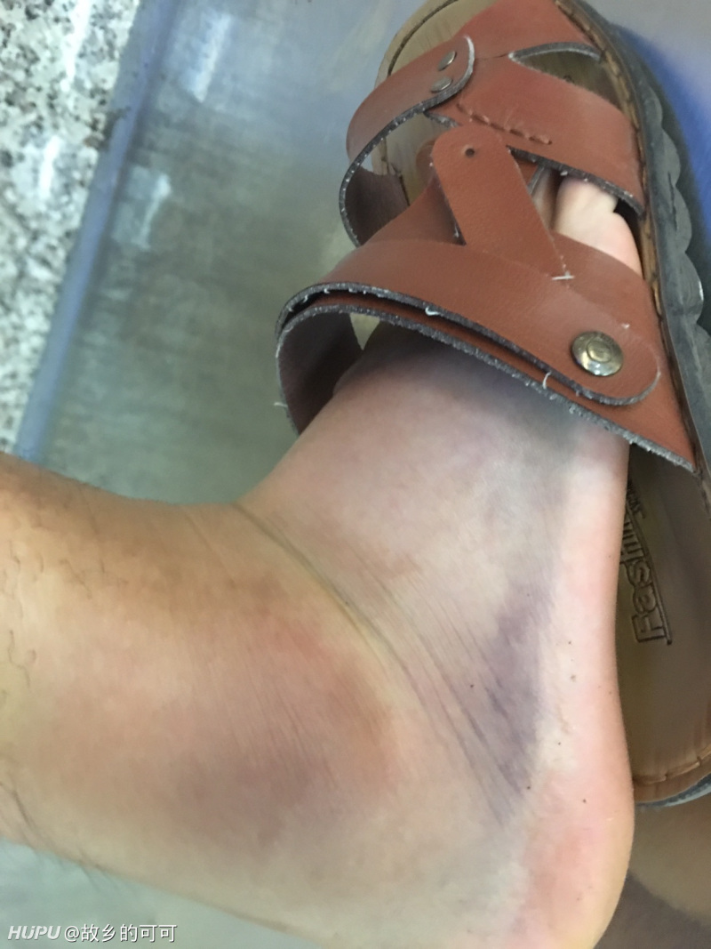 打球第一次扭到脚,要多久才能完全康复