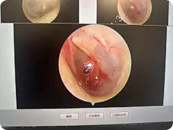男子扫墓时违规燃放鞭炮，致右耳鼓膜大面积穿孔